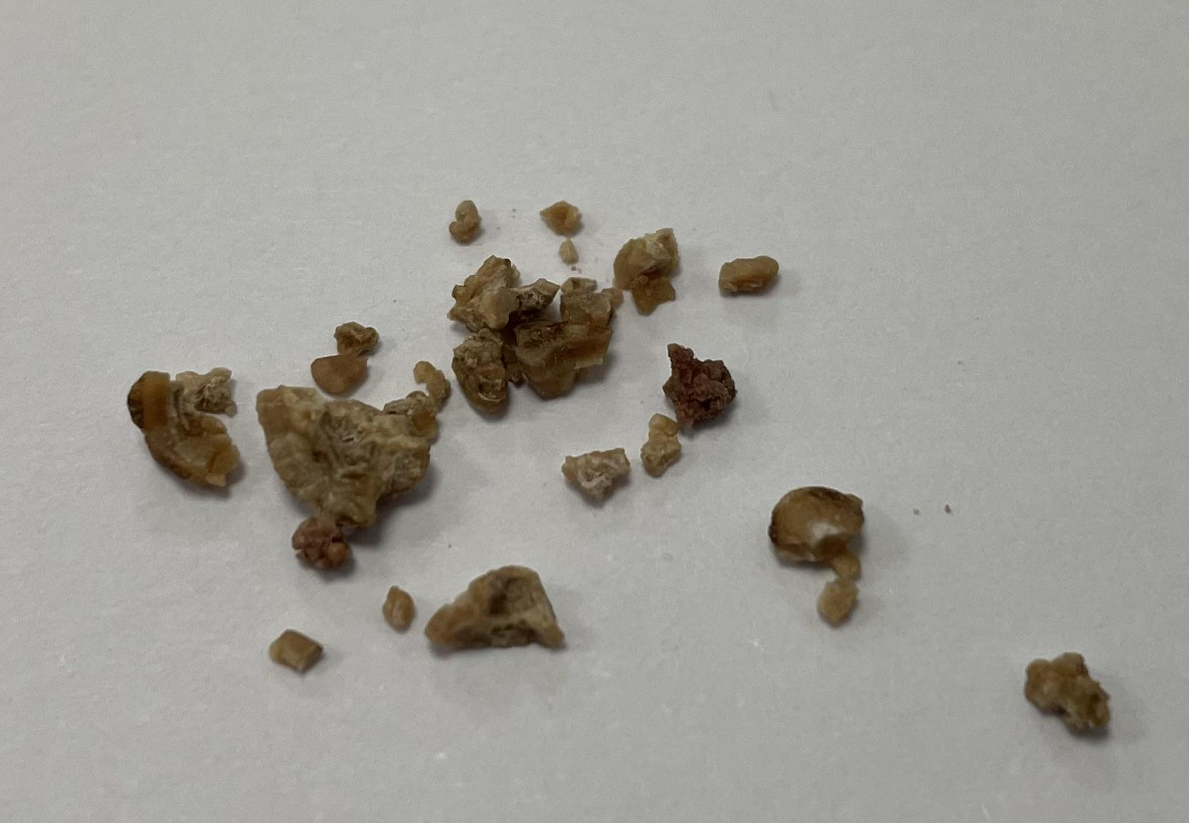 1760341019700418.png 草酸钙结石.png